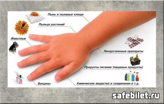 берут ли в армию с аллергией