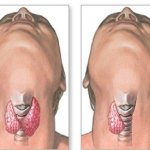 Что такое гипотиреоз