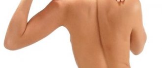 Кифосколиоз