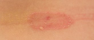 Лишай и армия: подлежат ли призыву юноши с таким диагнозом?