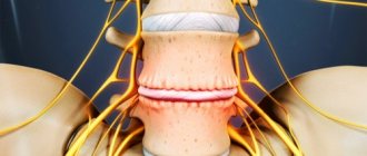 Межпозвоночная форма остеохондроза