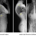 Обратите внимание на то, как выглядит кифоз на рентгене