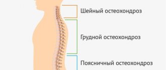 Остеохондроз