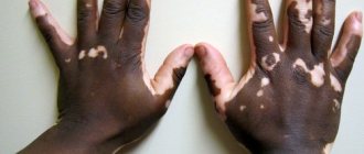Руки с болезнью витилиго